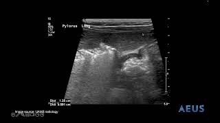 Pyloric Stenosis NLS Video [upl. by Devlin]