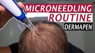 My Microneedling Routine and Derma Rolling for Hair Loss [upl. by Tlihcox]