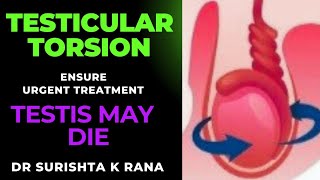 TESTICULAR TORSION for 4 WKS DETORSION amp ORCHIDOPEXY [upl. by Seerdi]