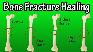 How Does A Bone Break Heal  Bone Fracture Healing Process [upl. by Besse62]