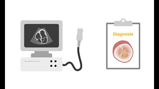 Assessing endocarditis with echocardiography [upl. by Autry]