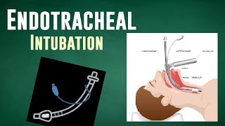 ENDOTRACHEAL INTUBATION  ET Tube Insertion [upl. by Pris]