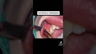 TOOTH ABSCESS Incision amp drainage [upl. by Anul]