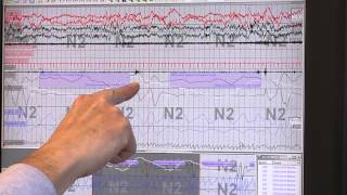 Reading Sleep Study Results Identifying Sleep Apnea [upl. by Yltnerb]