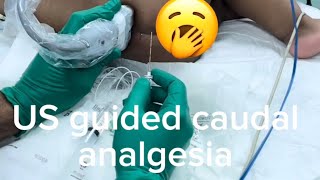 US guided caudal anesthesia [upl. by Aelak]