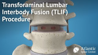 Transforaminal Lumbar Interbody FusionTLIF Procedure [upl. by Neenej14]