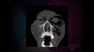 Imaging of facial fractures [upl. by Harli]