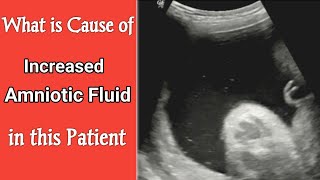 Ultrasound 8 month Pregnancy Cause of Increased Amniotic Fluid [upl. by Agatha]