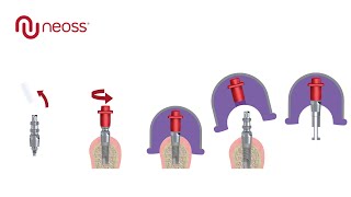 Neoss® Closed Tray Impressions [upl. by Margarethe]