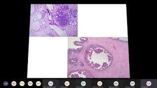 benign proliferative breast lesions [upl. by Llertnad]