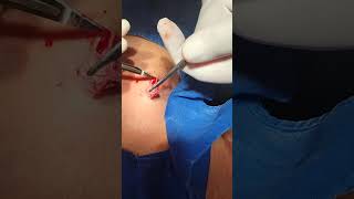 Dorsal Cyst Excision [upl. by Hsur]