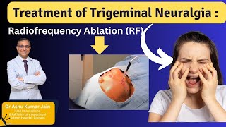 Relief from Trigeminal Neuralgia Effective Treatment with Radiofrequency Ablation [upl. by Yendis]