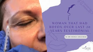 Woman That Had Botox Over Last 20 Years Testimonial [upl. by Ketty]