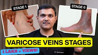 Varicose Veins From STAGES to SOLUTIONS Expert Guidance by Vascular Surgeon [upl. by Wanda]