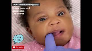 Post Frenectomy Therapy and Exercises for Baby [upl. by Adnak31]