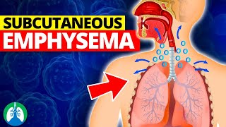 Subcutaneous Emphysema Medical Definition  Quick Explainer Video [upl. by My]