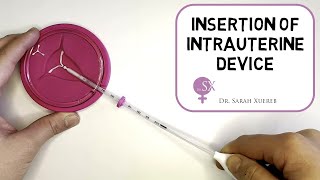 Insertion of Intrauterine Device [upl. by Esau]