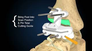 Exactech Vantage Ankle PSI Animation [upl. by Lathan]