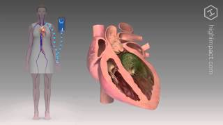 Endocarditis  Proper Antibiotic [upl. by Dane]