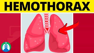 Hemothorax Medical Definition  Quick Explainer Video [upl. by Enenstein]