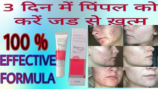 ACNETOIN GEL  चेहरे के दाग धब्बे पिंपल्स को कैसे रोकें  pimple Acnetoingel फुंसी मुंहासे [upl. by Eirased]