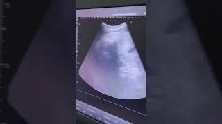 ANTENATAL ULTRASOUND PART 1 [upl. by Ivah]