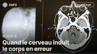 Trouble neurologique fonctionnel  quand le cerveau déraille  Découverte [upl. by Jonis]