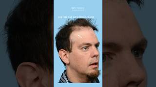 Fill in balding spots and thinning hair with an FUE Hair Transplant hairrestoration [upl. by Aikemat]