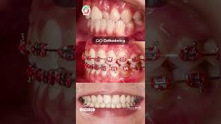 GiO Orthodontics [upl. by Iaw728]