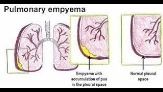 Pleural Empyema  empyema  causes symptoms treatment  empyema medicine lecture  empyema [upl. by Othilie]