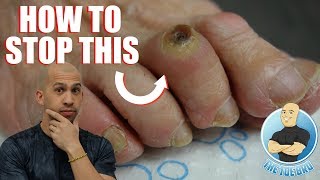 FOOT CORN REMOVAL FULL TREATMENT  FOOT HEALTH MONTH 2018 3 [upl. by Fisa]