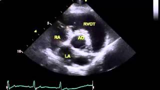 Normal canine echo  right parasternal shortaxis view at the level of the heart base [upl. by Norrat]