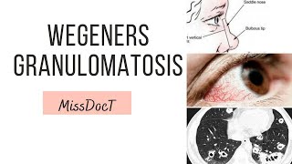 GRANULOMATOSIS WITH POLYANGITIS Wegeners Granulomatosis [upl. by Uah]