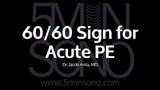 6060 Sign for Acute PE [upl. by Camroc627]