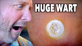 HUGE DECAYING WART Frozen With Liquid Nitrogen  Dr Paul [upl. by Rella568]