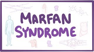 Marfan Syndrome  causes symptoms diagnosis treatment pathology [upl. by Colson515]