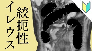 【おきらく版】第１６回：絞扼性イレウス 索状物による腸閉塞（イレウス）のCT画像 [upl. by Suiradal223]