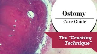 The Ostomy Crusting Technique Explained [upl. by Farhi375]