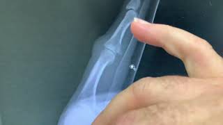 Finger joint dislocation or How to treat a dislocated finger good advice from a hand surgeon [upl. by Nnahtebazile]