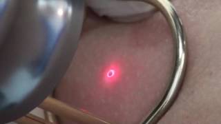 Mole removal fractional CO2 laser [upl. by Rebmeced844]