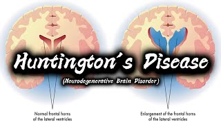 Huntingtons Disease  Types  Symptoms  Causes  Diagnosis  Treatment Options  Preventions [upl. by Ynnaj]