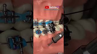 ¡Instalación de microimplante dental en los BRACKETS 😬ANCLAJE ESQUELÉTICO SIN DOLOR😫 [upl. by Ydorb]