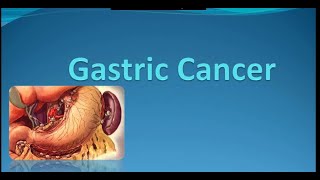 Gastric Cancer Surgery Lecture Symptoms  Diagnosis and Treatment [upl. by Annaili]