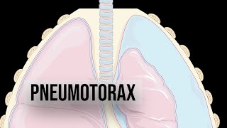 Ce înseamnă pneumotorax [upl. by Azirb]