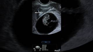 8 weeks fetus subchorionic hemorrhage peri sac hematoma ultrasound ardms sonography radiology [upl. by Jessey]