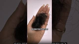 The Hair Growth Serum That Grew My Hair back hairgrowth hairfall hairfallsolution wishcare [upl. by Thomson]