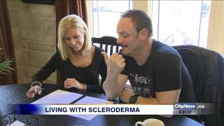 Video Living with scleroderma [upl. by Ocsirf]