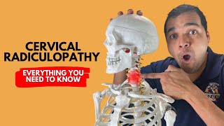 Cervical Radiculopathy Everything You Need To Know To Get Better Without Surgery [upl. by Oloapnaig]