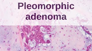 Pleomorphic Adenoma of Salivary Gland [upl. by Tandy]