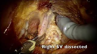 Nerve sparing Robotic Assisted Radical Prostatectomy final Full video [upl. by Aynna]